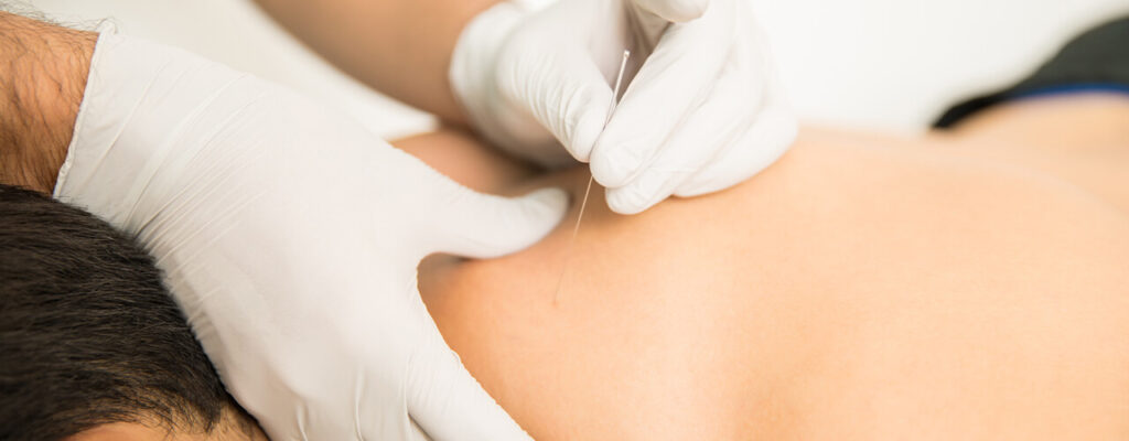 Physical therapist applying dry needling treatment to a patients back to alleviate pain.