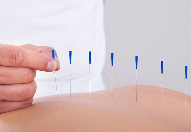 How Dry Needling Can Relieve Your Pain
