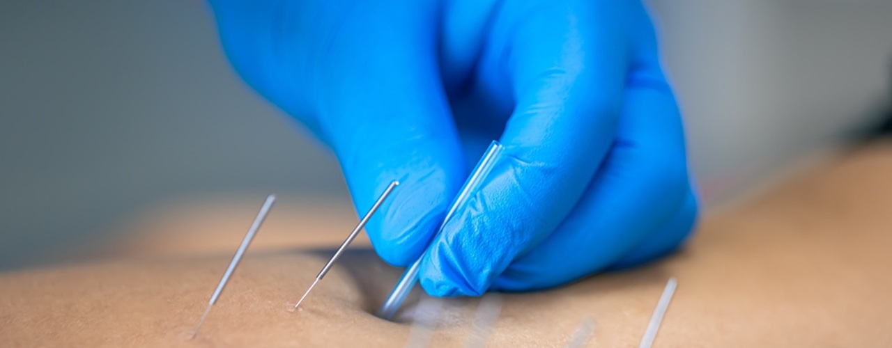 Is Dry Needling Right for You?